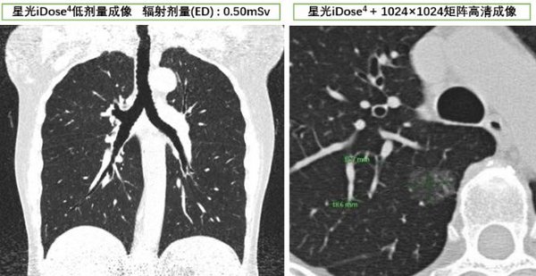 飞利浦星光iDose4可提高早期患者的确诊率